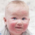 کدام بیماری‌های پوستی در کودکان شایع هستند؟