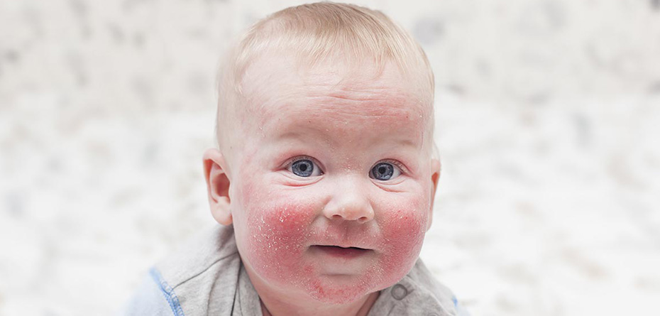 کدام بیماری‌های پوستی در کودکان شایع هستند؟